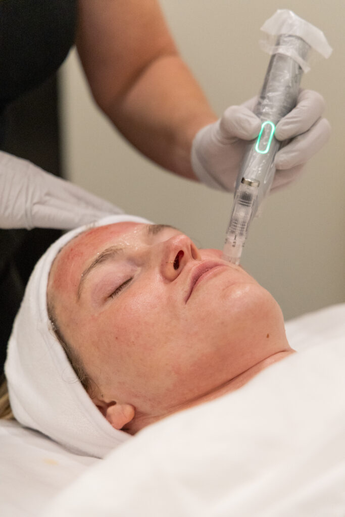 Girl relaxing getting microneedling facial 